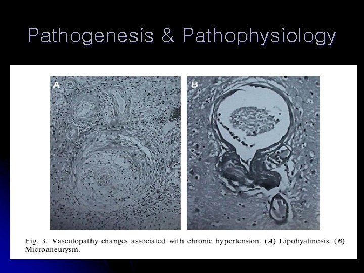 Pathogenesis & Pathophysiology 