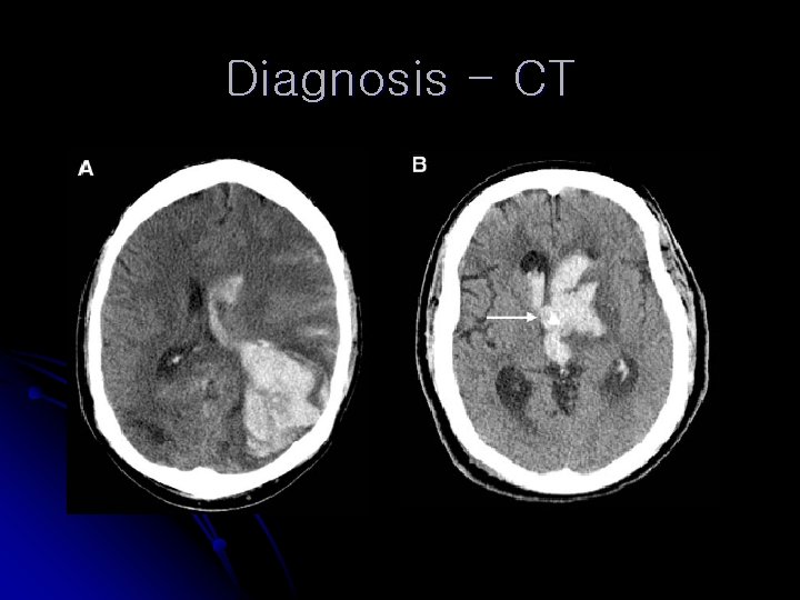 Diagnosis - CT 