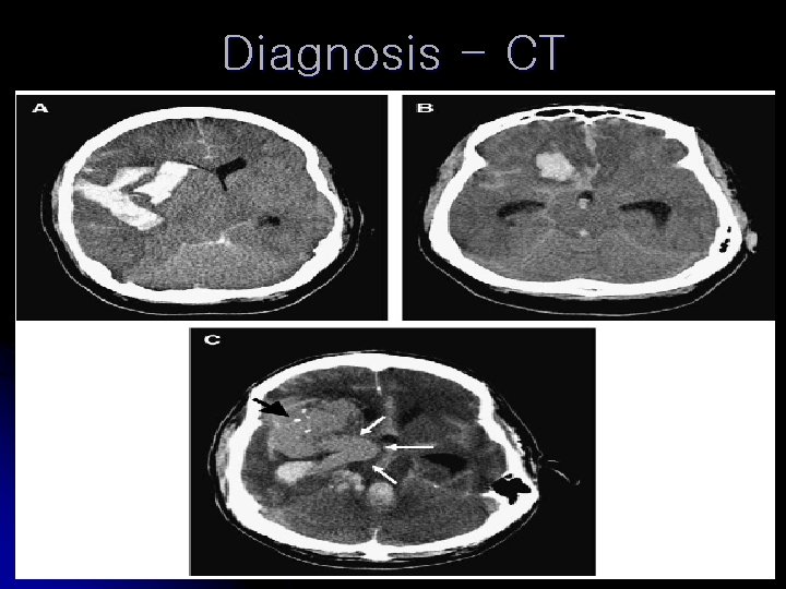 Diagnosis - CT 