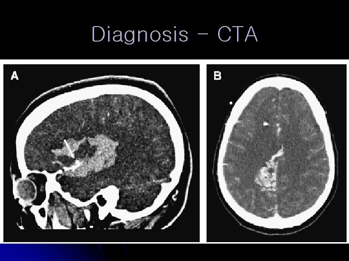 Diagnosis - CTA 