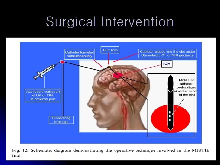 Surgical Intervention 