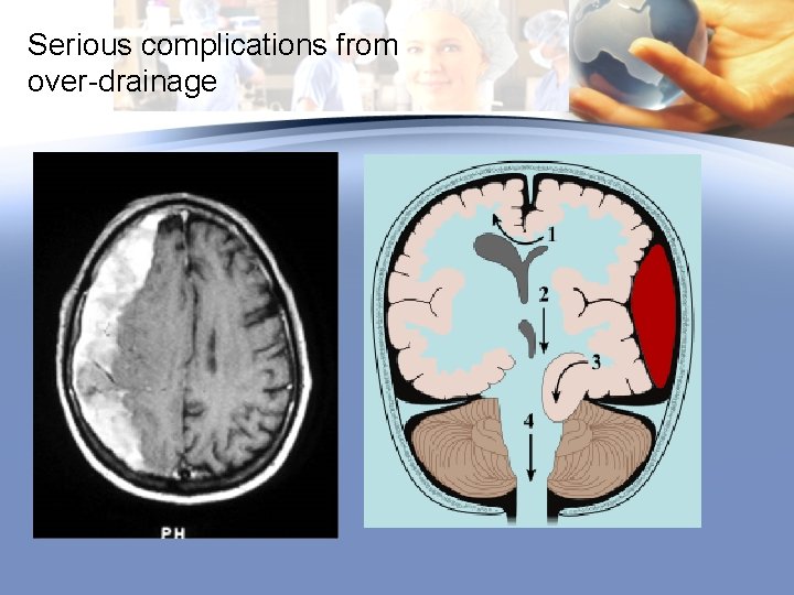 Serious complications from over-drainage 