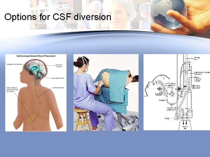 Options for CSF diversion 