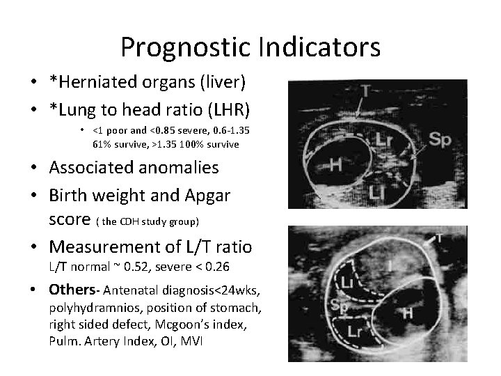 Prognostic Indicators • *Herniated organs (liver) • *Lung to head ratio (LHR) • <1