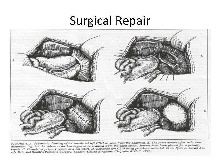 Surgical Repair 