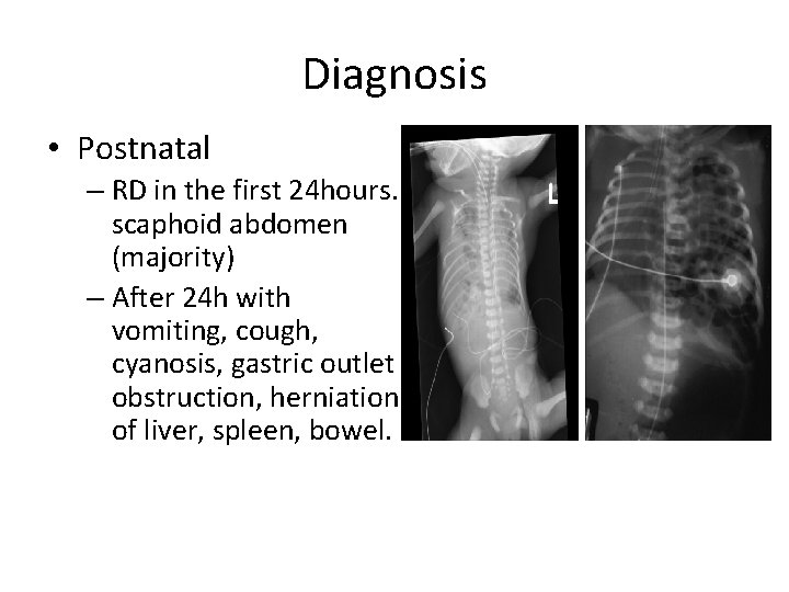Diagnosis • Postnatal – RD in the first 24 hours. scaphoid abdomen (majority) –
