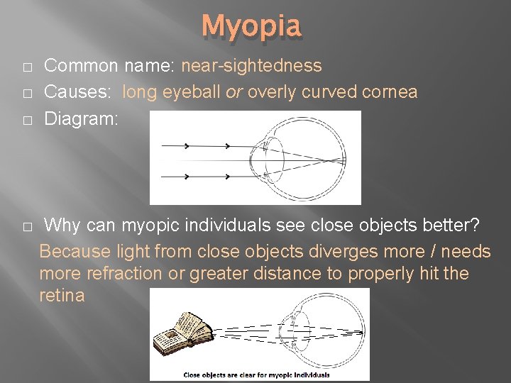 Myopia � � Common name: near-sightedness Causes: long eyeball or overly curved cornea Diagram: