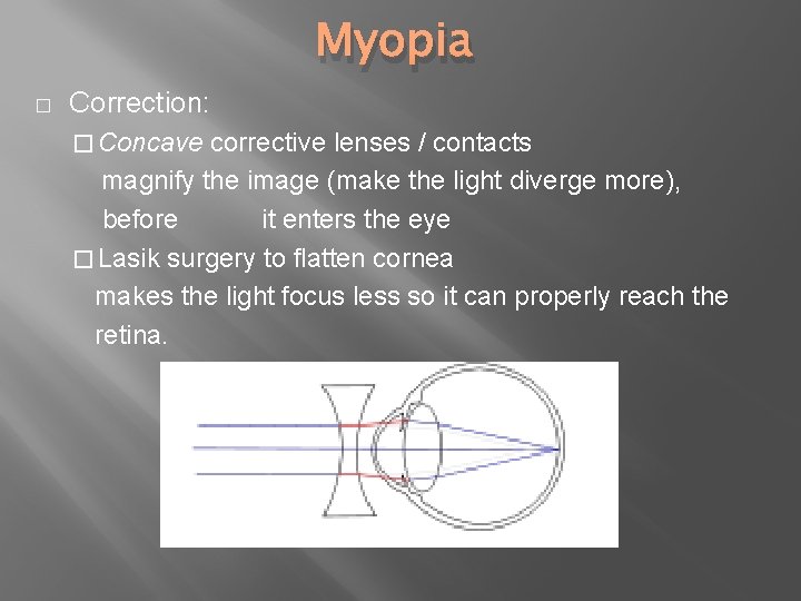 Myopia � Correction: � Concave corrective lenses / contacts magnify the image (make the