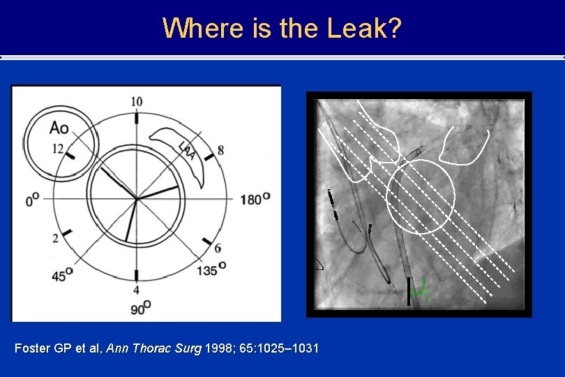 Where is the Leak? Foster GP et al, Ann Thorac Surg 1998; 65: 1025–