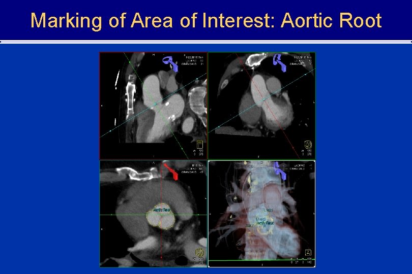 Marking of Area of Interest: Aortic Root 