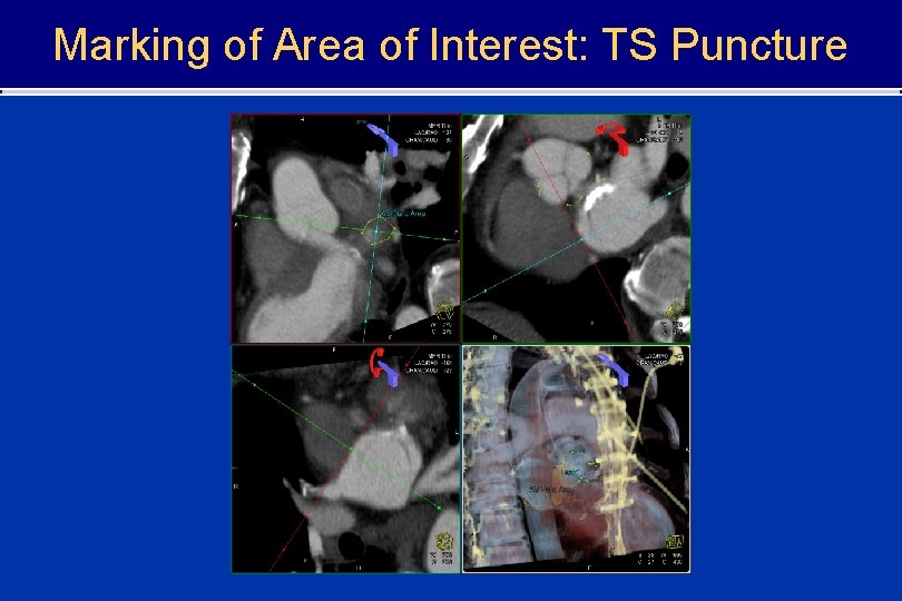 Marking of Area of Interest: TS Puncture 