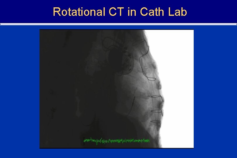 Rotational CT in Cath Lab 