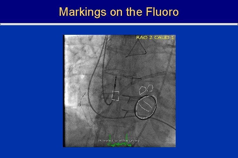 Markings on the Fluoro 