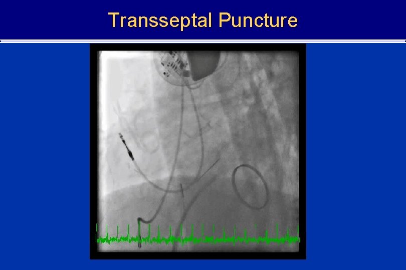 Transseptal Puncture 