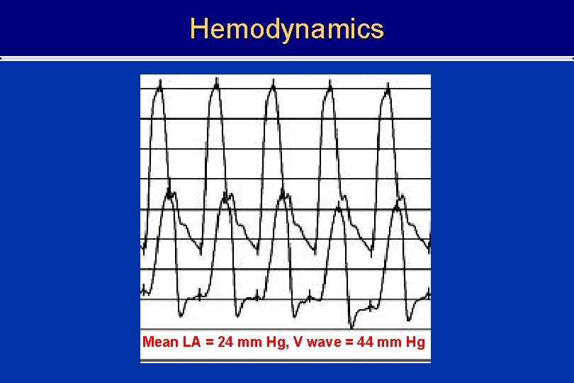 Hemodynamics Mean LA = 24 mm Hg, V wave = 44 mm Hg 