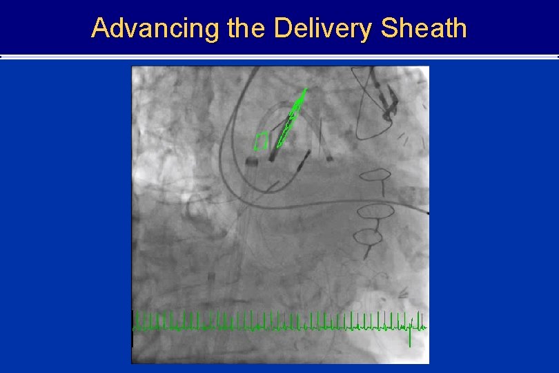 Advancing the Delivery Sheath 
