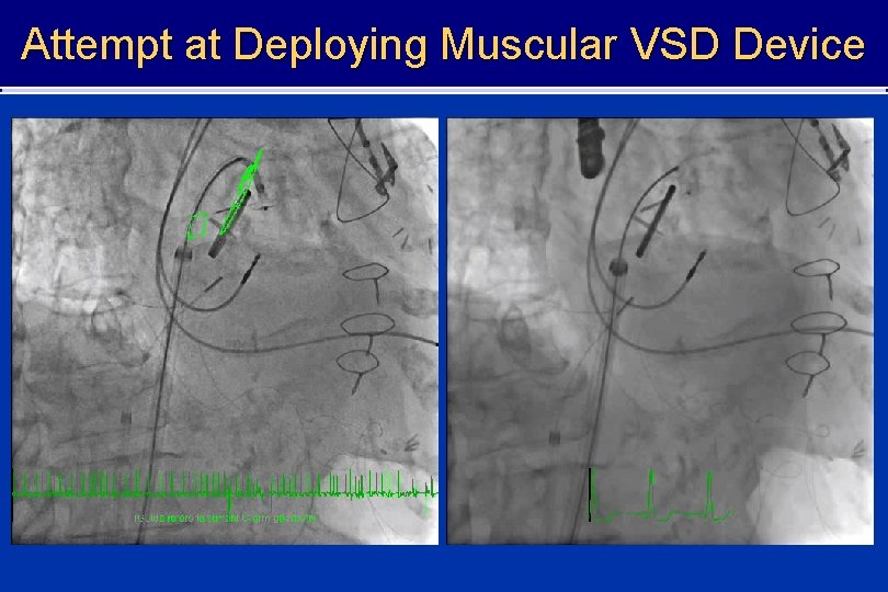 Attempt at Deploying Muscular VSD Device 