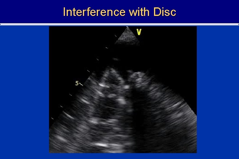 Interference with Disc 