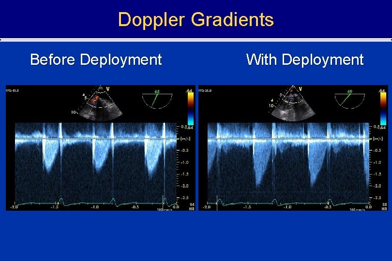 Doppler Gradients Before Deployment With Deployment 
