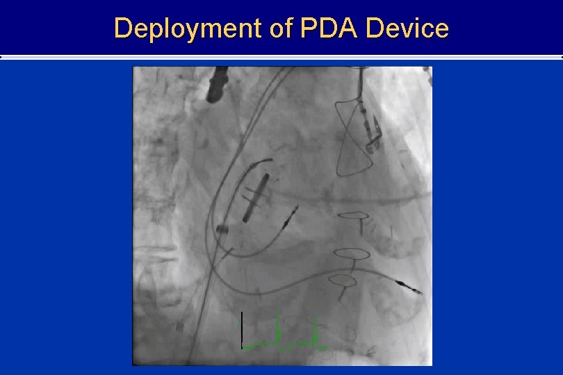 Deployment of PDA Device 