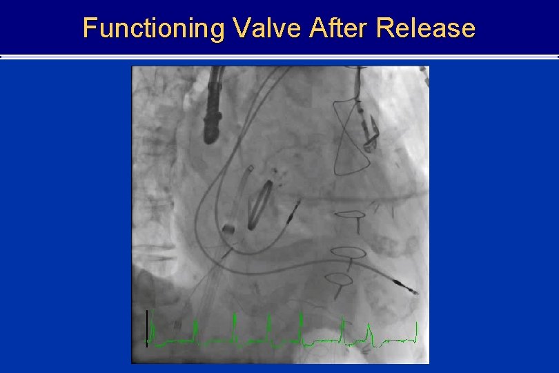 Functioning Valve After Release 