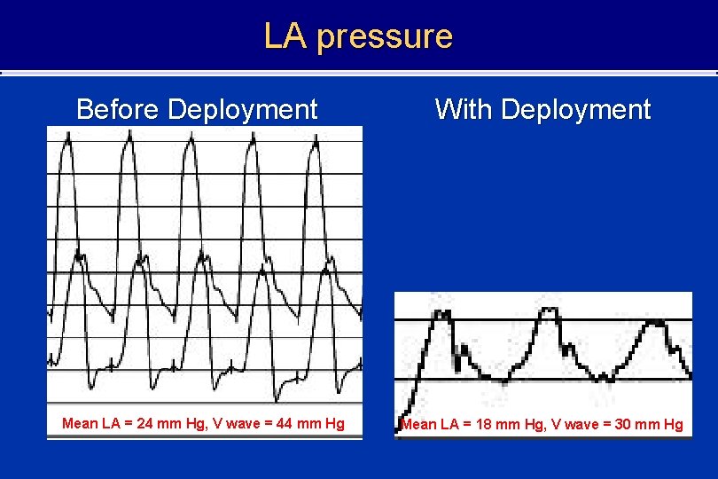 LA pressure Before Deployment Mean LA = 24 mm Hg, V wave = 44