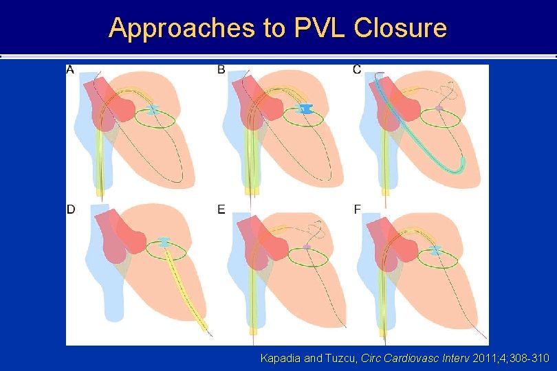 Approaches to PVL Closure Kapadia and Tuzcu, Circ Cardiovasc Interv 2011; 4; 308 -310