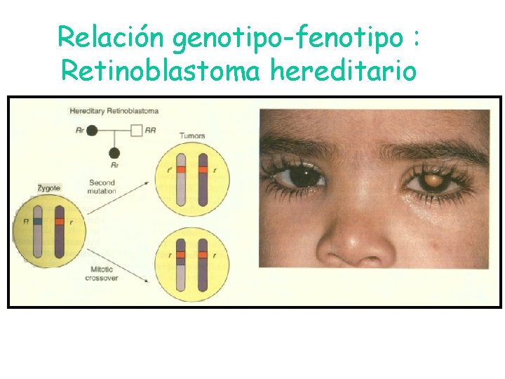 Relación genotipo-fenotipo : Retinoblastoma hereditario Relación genotipo-fenotipo : Retinoblastoma hereditario