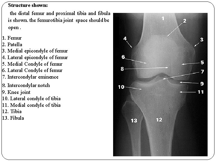 Structure shown: the distal femur and proximal tibia and fibula is shown. the femurotibia