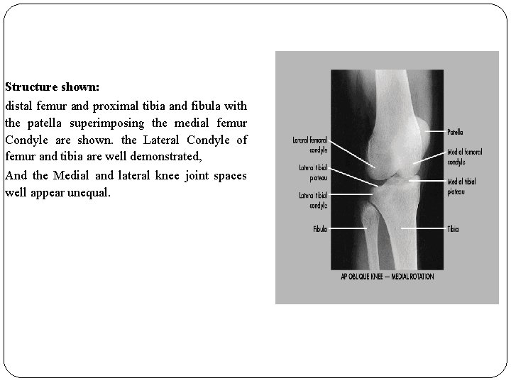 Structure shown: distal femur and proximal tibia and fibula with the patella superimposing the