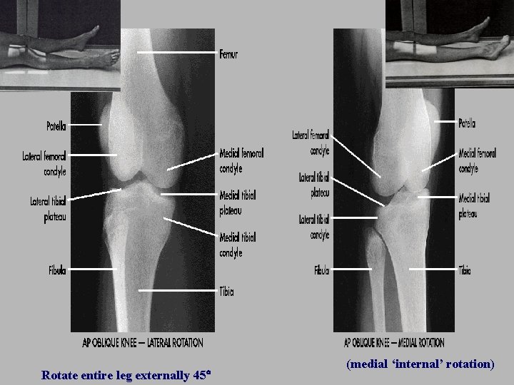 Rotate entire leg externally 45 (medial ‘internal’ rotation) 