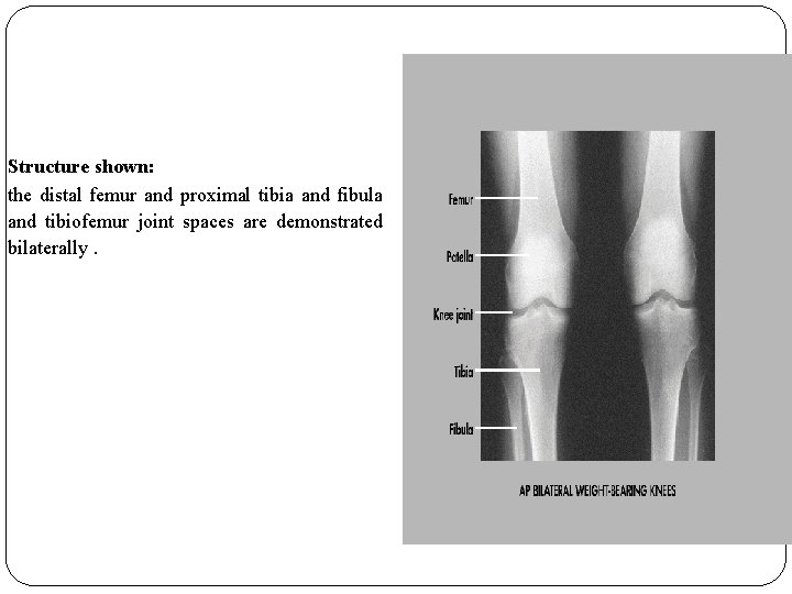 Structure shown: the distal femur and proximal tibia and fibula and tibiofemur joint spaces