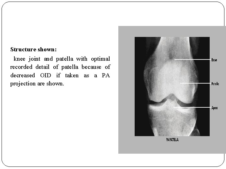 Structure shown: knee joint and patella with optimal recorded detail of patella because of