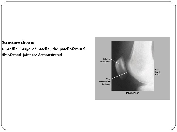 Structure shown: a profile image of patella, the patellofemural tibiofemral joint are demonstrated. 