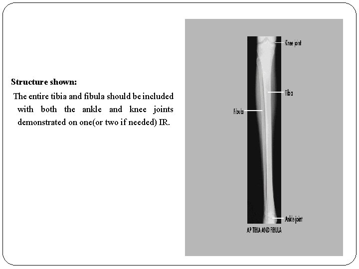 Structure shown: The entire tibia and fibula should be included with both the ankle