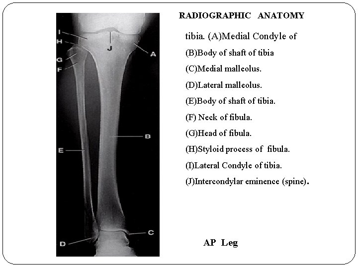 RADIOGRAPHIC ANATOMY tibia. (A)Medial Condyle of (B)Body of shaft of tibia (C)Medial malleolus. (D)Lateral