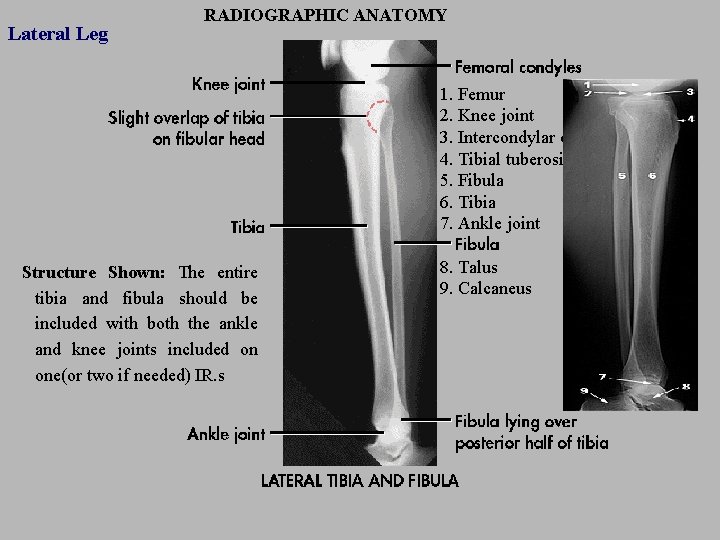 Lateral Leg RADIOGRAPHIC ANATOMY 1. Femur 2. Knee joint 3. Intercondylar eminence 4. Tibial