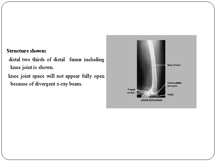 Structure shown: distal two thirds of distal femur including knee joint is shown. knee