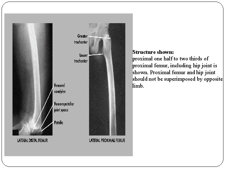 Structure shown: proximal one half to two thirds of proximal femur, including hip joint