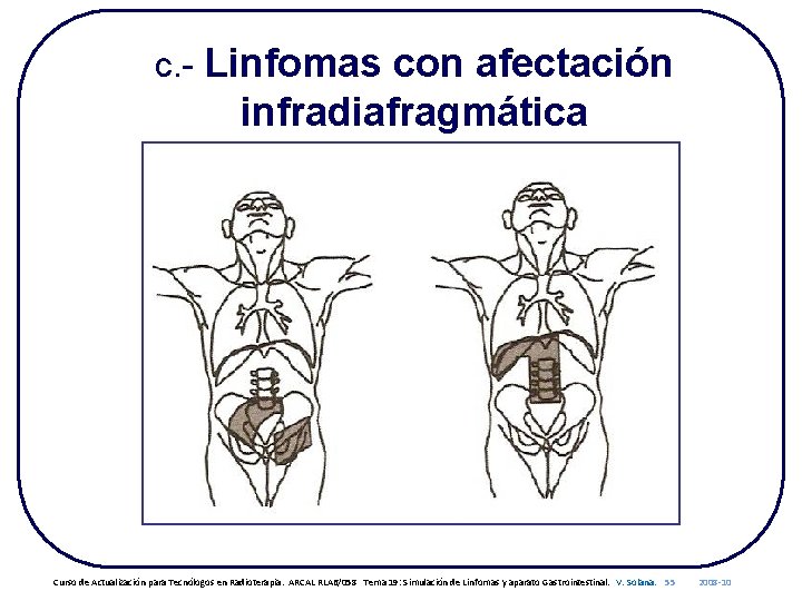 c. - Linfomas con afectación infradiafragmática Curso de Actualización para Tecnólogos en Radioterapia. ARCAL
