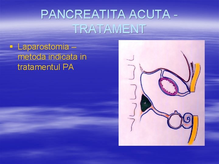 PANCREATITA ACUTA TRATAMENT § Laparostomia – metoda indicata in tratamentul PA 
