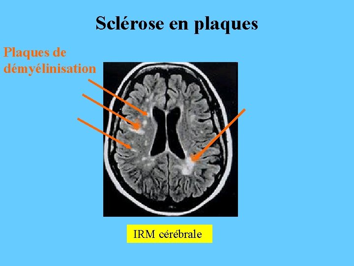 Sclérose en plaques Plaques de démyélinisation IRM cérébrale 