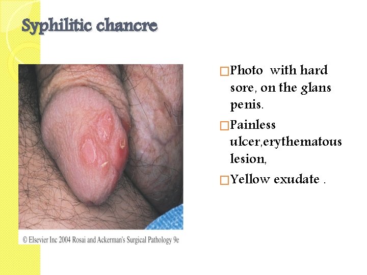 Syphilitic chancre �Photo with hard sore, on the glans penis. �Painless ulcer, erythematous lesion,