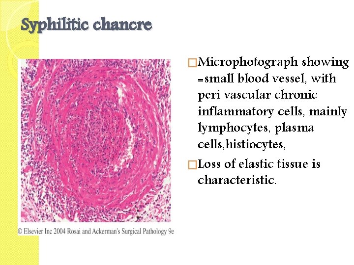 Syphilitic chancre �Microphotograph showing =small blood vessel, with peri vascular chronic inflammatory cells, mainly