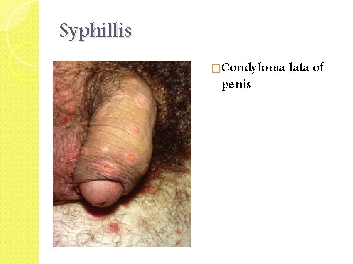 Syphillis �Condyloma lata of penis 