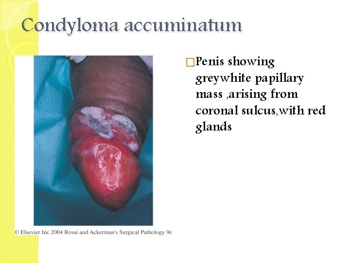 Condyloma accuminatum �Penis showing greywhite papillary mass , arising from coronal sulcus, with red