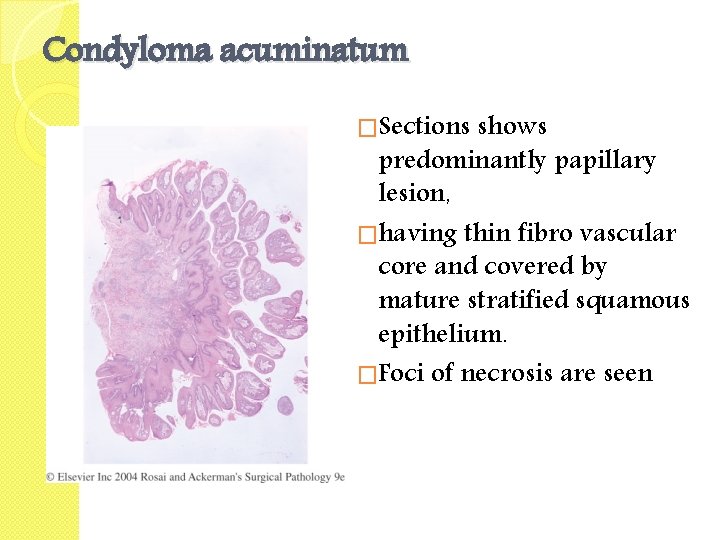 Condyloma acuminatum �Sections shows predominantly papillary lesion, �having thin fibro vascular core and covered