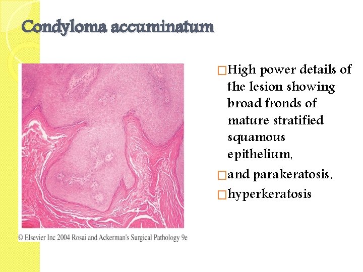 Condyloma accuminatum �High power details of the lesion showing broad fronds of mature stratified