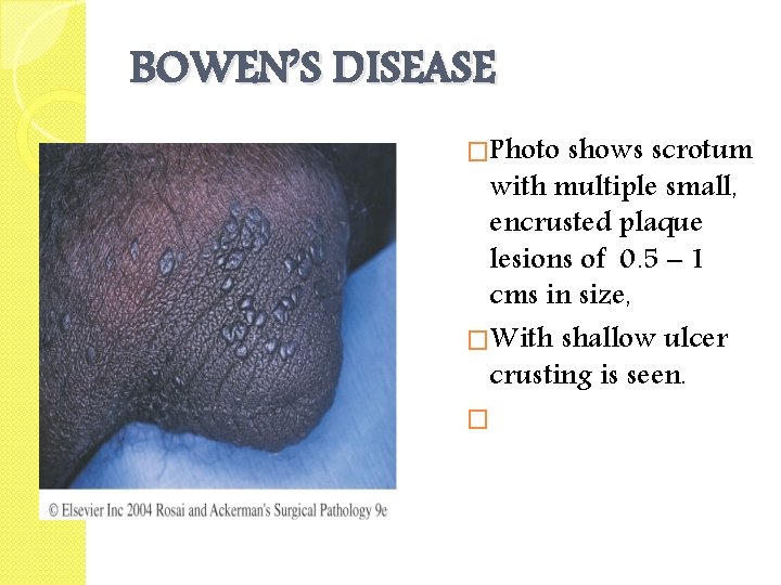 BOWEN’S DISEASE �Photo shows scrotum with multiple small, encrusted plaque lesions of 0. 5