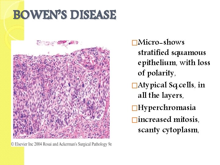 BOWEN’S DISEASE �Micro-shows stratified squamous epithelium, with loss of polarity, �Atypical Sq. cells, in